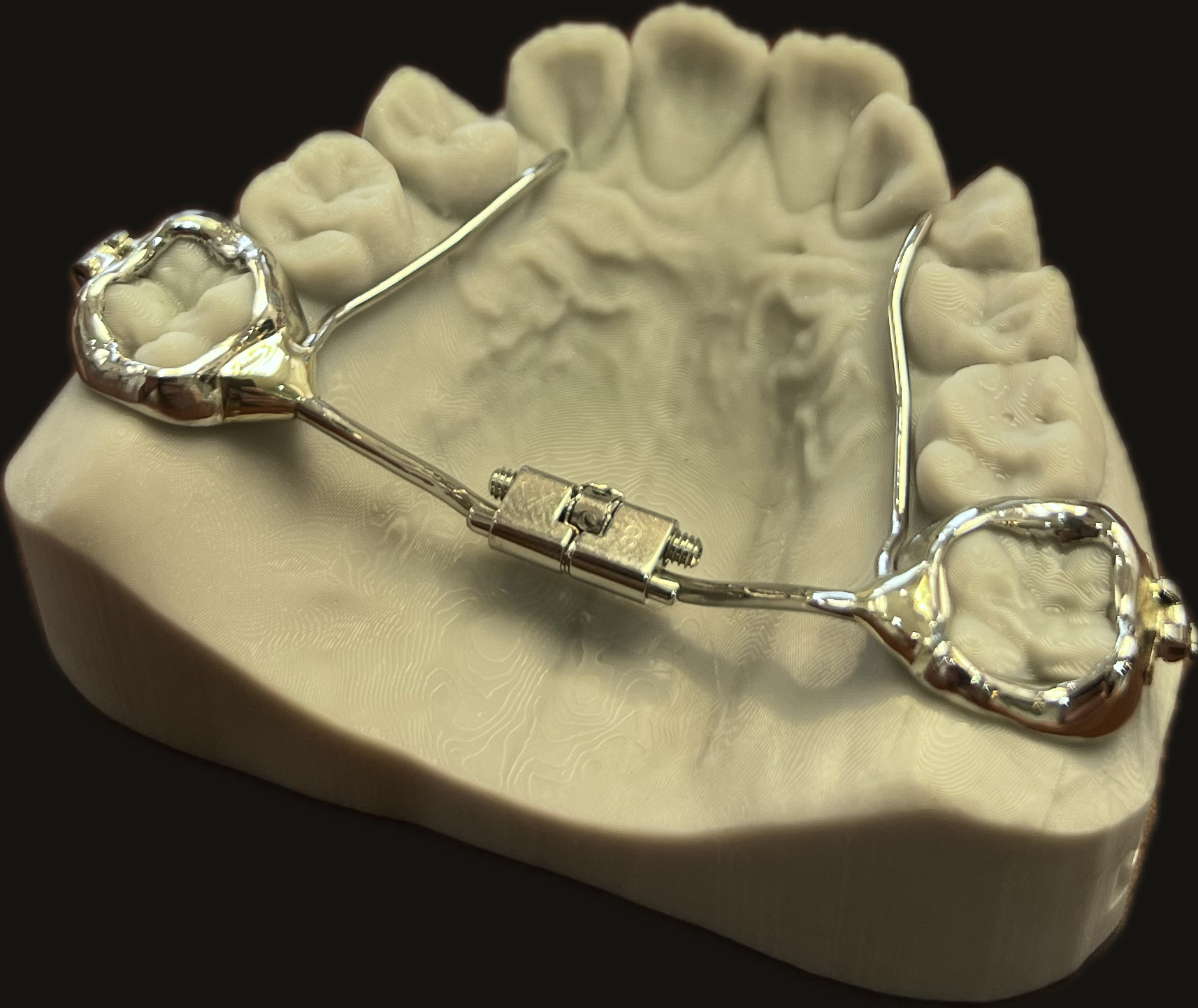 Banded Nance-arch appliance on stone model