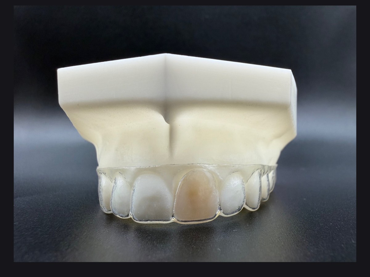 Invisible Retainer with Pontic