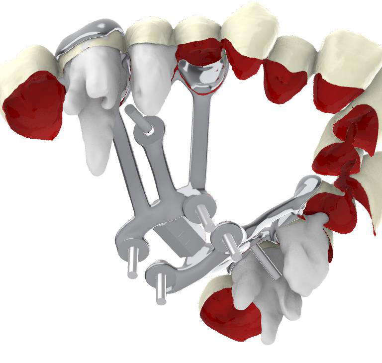 Metal-printed expander frame