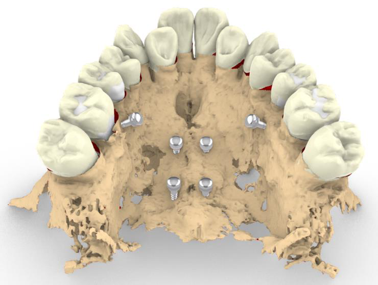 Maxillary expander on model (occlusal)