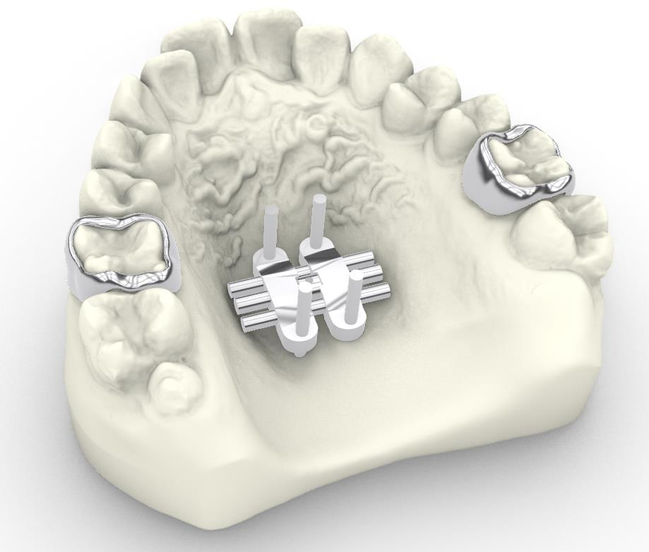 Metal 3D-printed MSE frame on a digital model