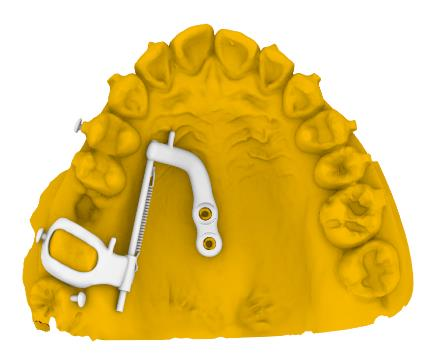 Lingual Mesializer