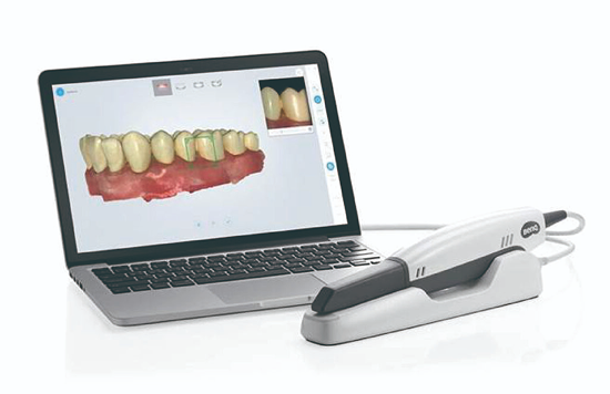 Intraoral scanning of a dental model