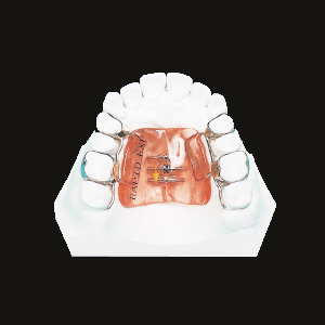 Rapid Expansion (Haas Type)