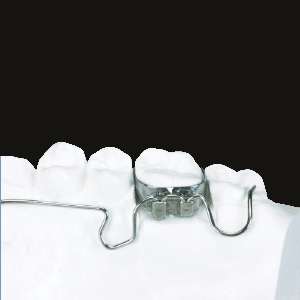 (d) Lingual Arch with 3D