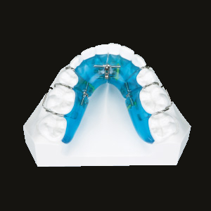 Sagittal Appliance (Lower)