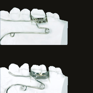 310 Quad Helix with Sheath