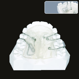 Traction Screw (Anterior)