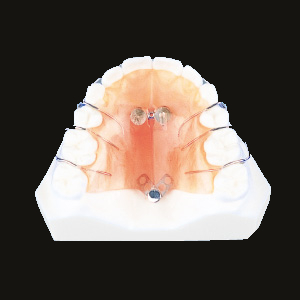 Expansion (Upper Fan Type)