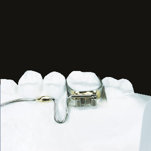 (b) Lingual Arch with ST Lock