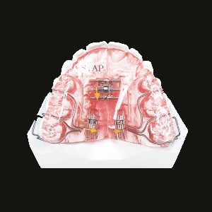 Sagittal Appliance (Upper)